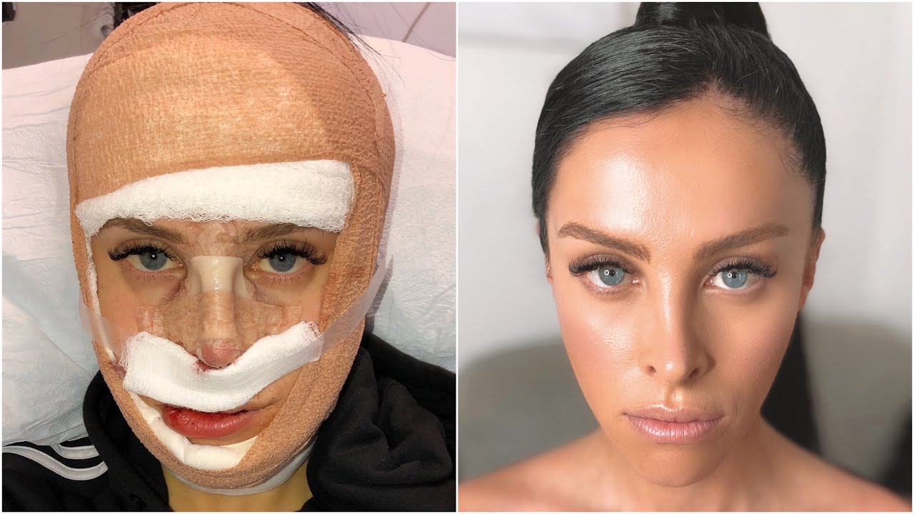 I GOT FACIAL FEMINISATION SURGERY WITH DR HARRISON LEE|| AUSSIE TRANS GIRL IN BEVERLY HILLS| Haydie