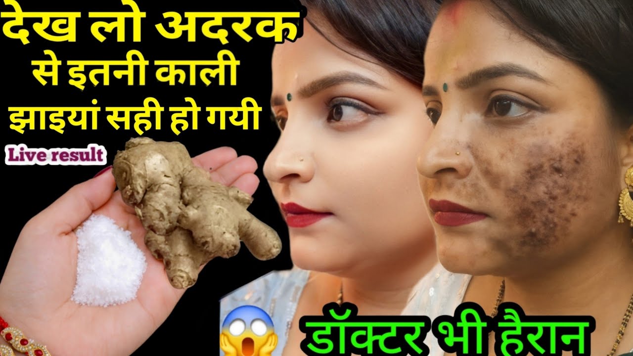 अदरक से झाइयां हटाने का कमाल का तरीका Reduce Melasma, Pigmentation, Discolouration Blackspots