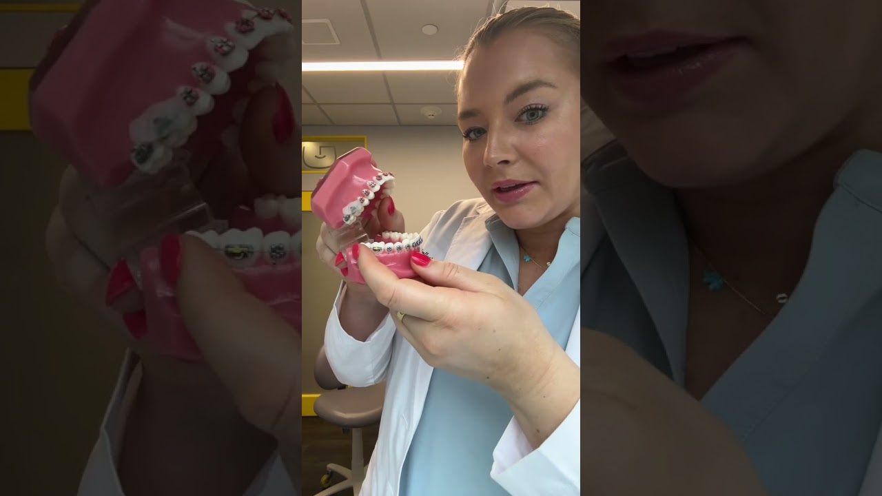 How to fix lock jaw at home! #lockjaw #braces video cred: Sinatra