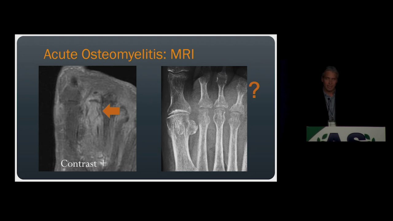 Imaging of Osteomyelitis & Septic Arthritis | 15 Minute Radiology CME