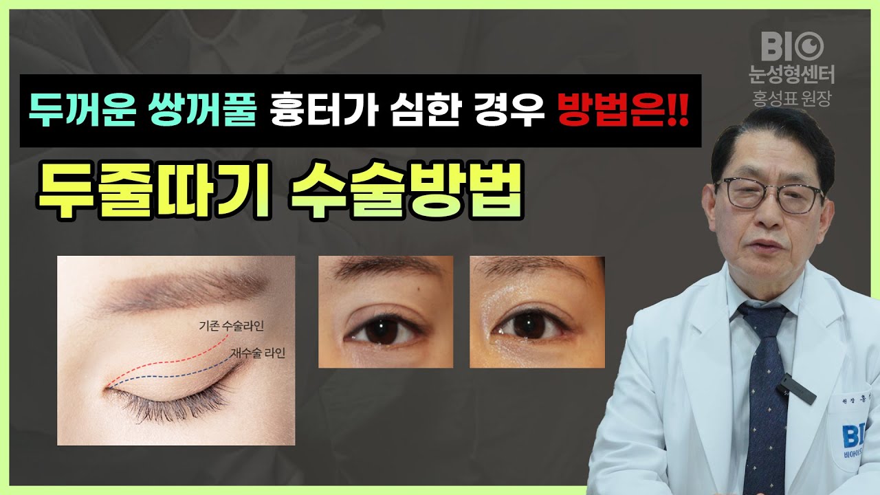 두꺼운 #쌍꺼풀, 흉터가 심한 경우에는 #두줄따기 수술방법 - BIO성형외과 홍성표원장