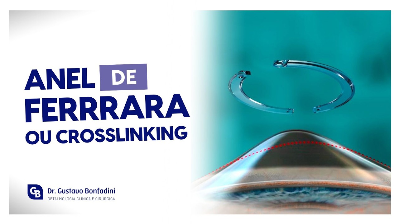 CIRURGIA PARA CERATOCONE: ANEL DE FERRARA OU CROSSLINKING ?