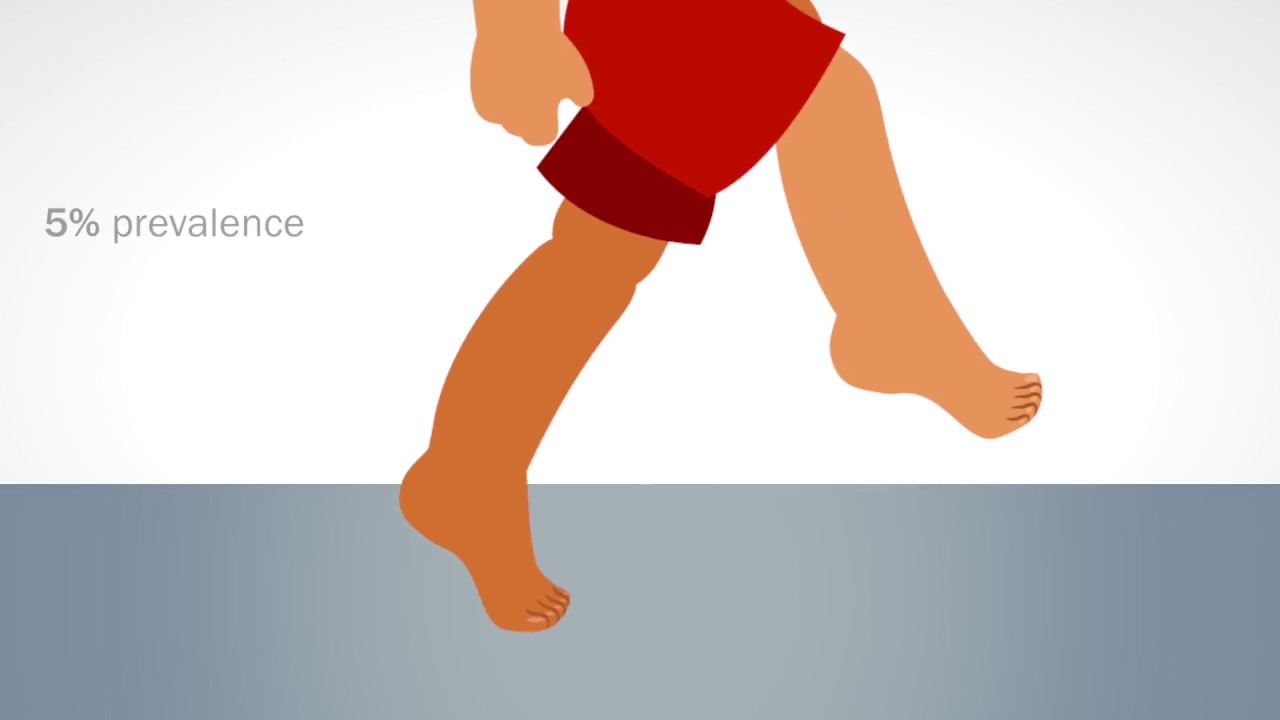 Idiopathic Toe-Walking: Prevalence and Natural History from Birth to Ten Years of Age
