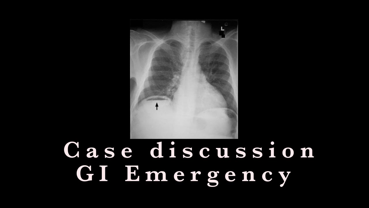 Surgical Emergency || Acute abdomen || Case discussion