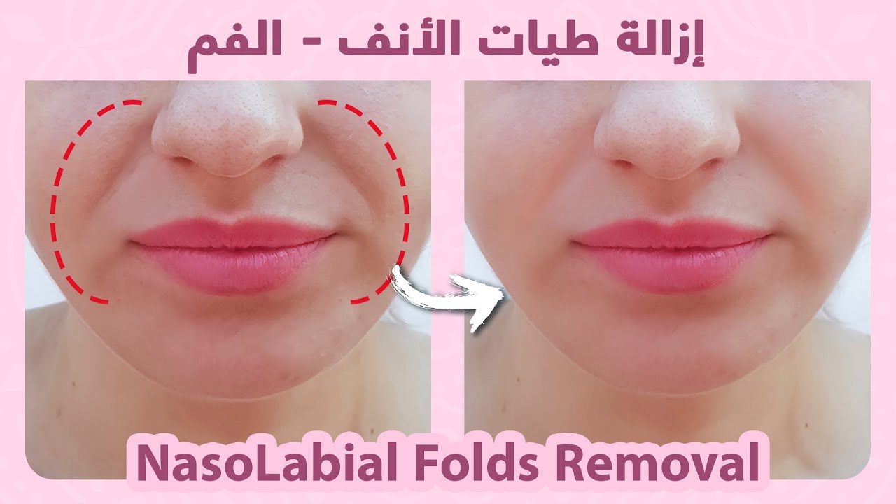 How to naturally remove nasolabial folds (smile lines)