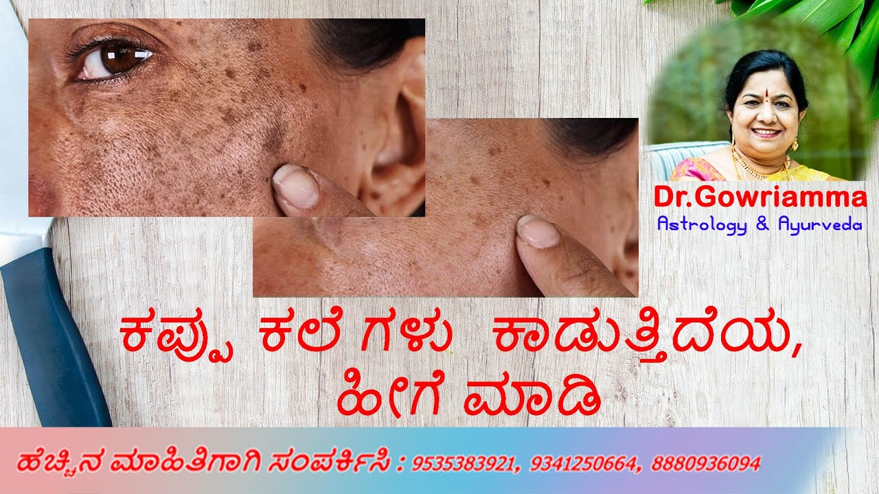 ಕಪ್ಪು ಕಲೆ ಗಳು  ಕಾಡುತ್ತಿದೆ ಯ,  ಹೀಗೆ ಮಾಡಿ - Dr. Gowriamma