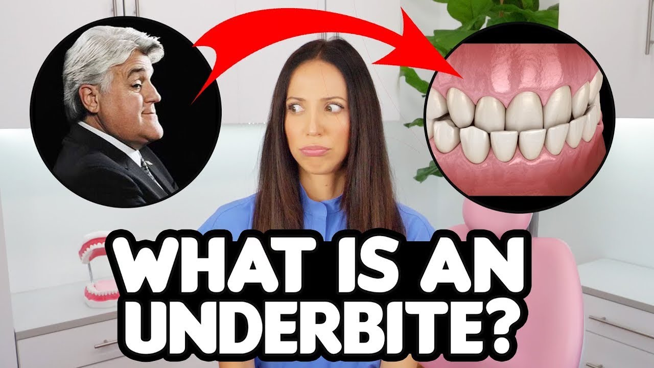 Underbite Correction EXPLAINED (causes & treatments)