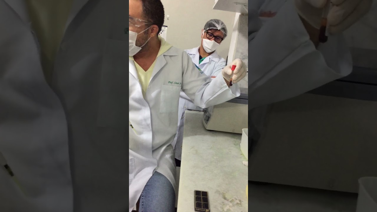 Diluição para titulação semi-quantitativa da Proteína C. Reativa (Resultado: Reagente 1/1 = 6 mg/dL)