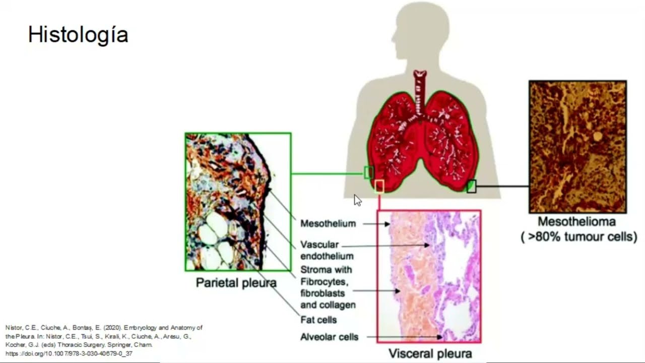 Fisiología de la pleura y derrame pleural - Hospital San Vicente Fundación