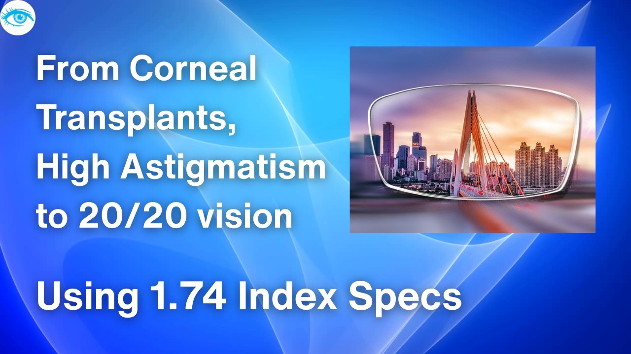 @eyeoptometrist From Corneal Transplants, High Astigmatism to 20/20 vision using 1.74 Index Specs