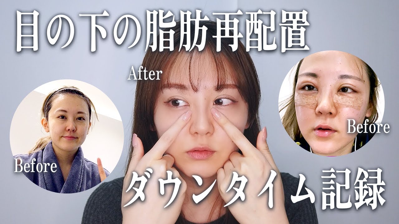 【ダウンタイム記録】エートップ整形外科で念願の目の下の脂肪再配置をしました！