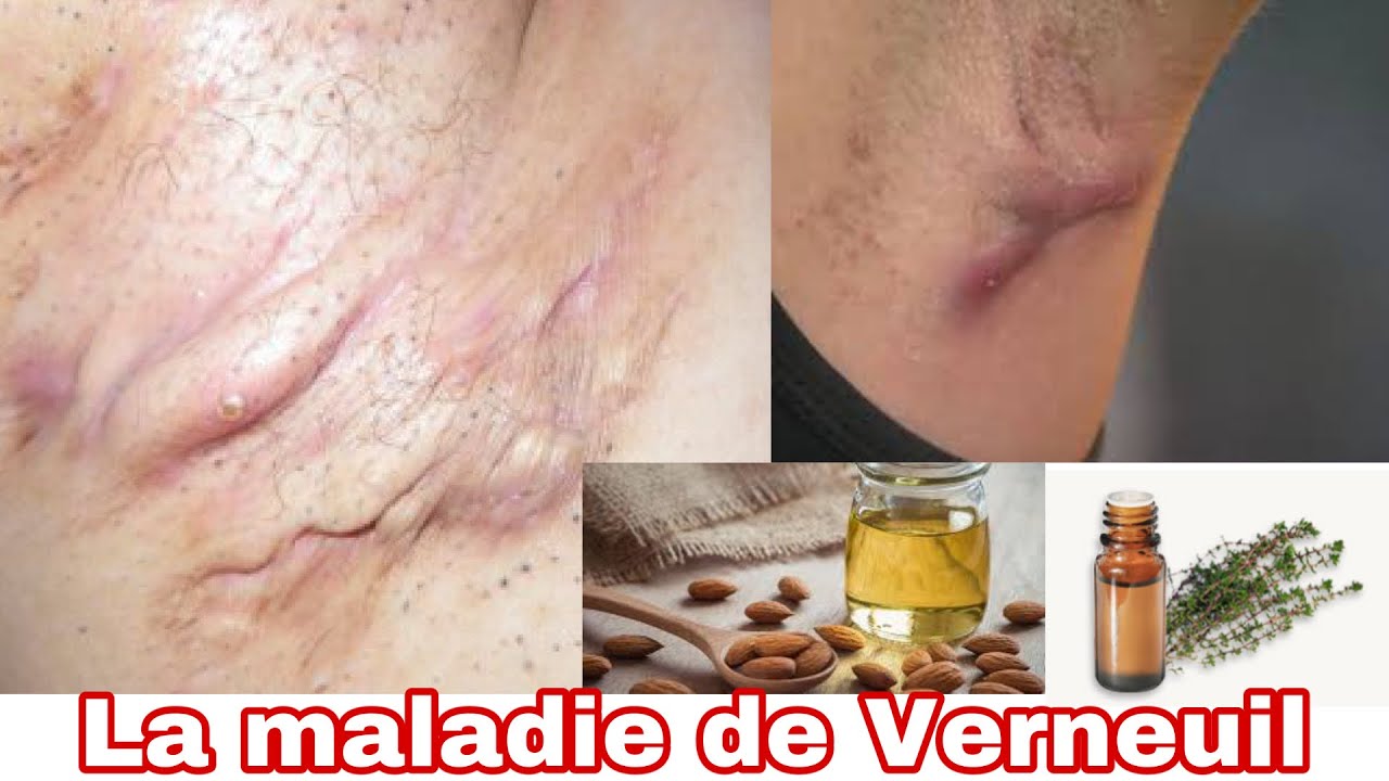 La maladie de Verneuil, Traitements naturels