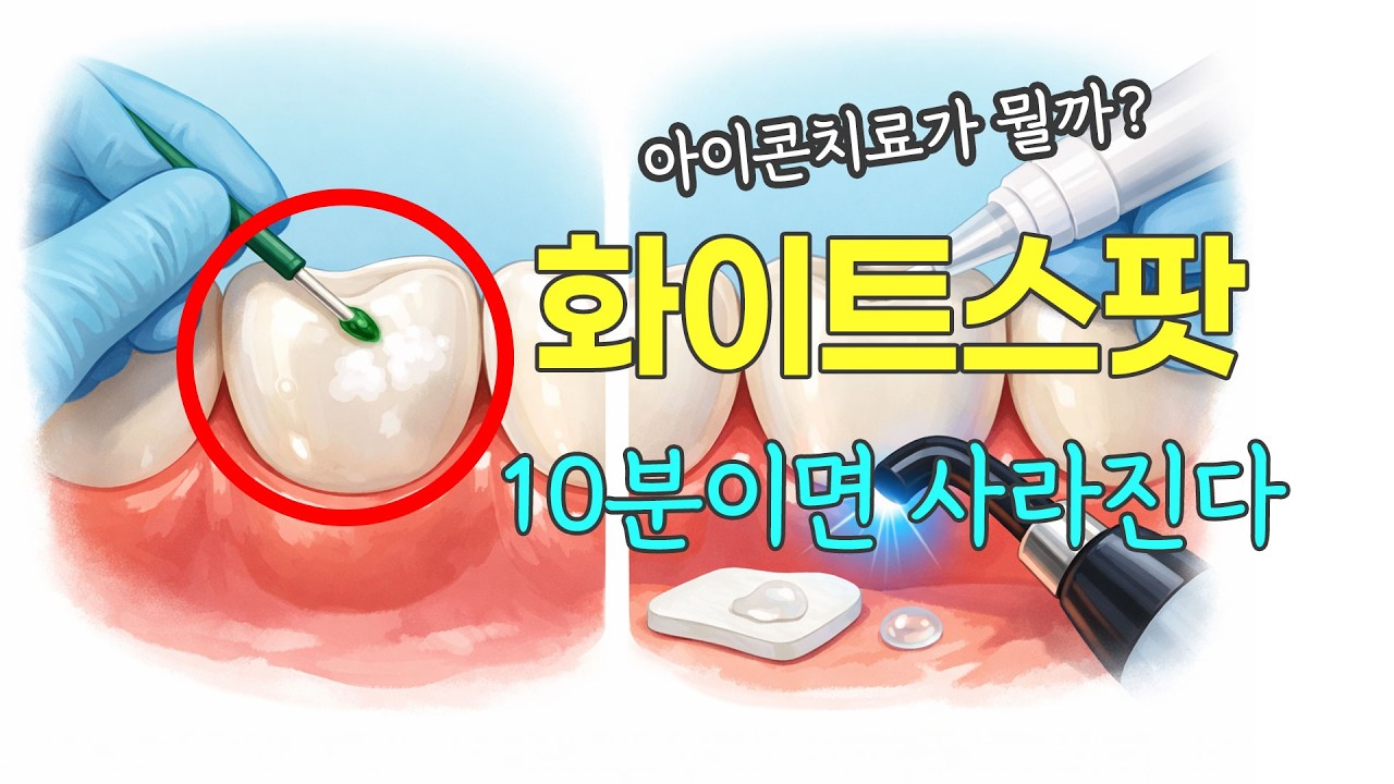 앞니 하얀 자국 100% 없애는 해결 방법은?