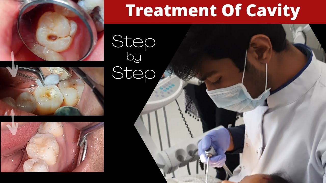 Composite Filling (Step by Step) || Cavity In Tooth || How To Fill Decayed Tooth || Dr. Sunil Kumar