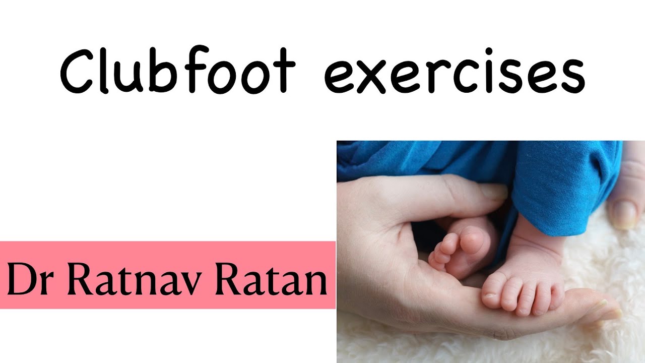 Clubfoot exercises|Dr Ratnav Ratan