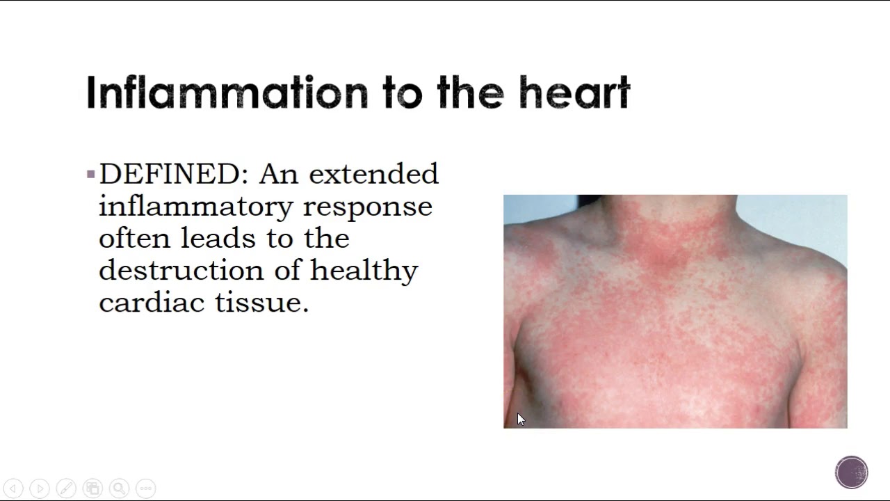 N330 Valvular & Inflammatory Heart disorders