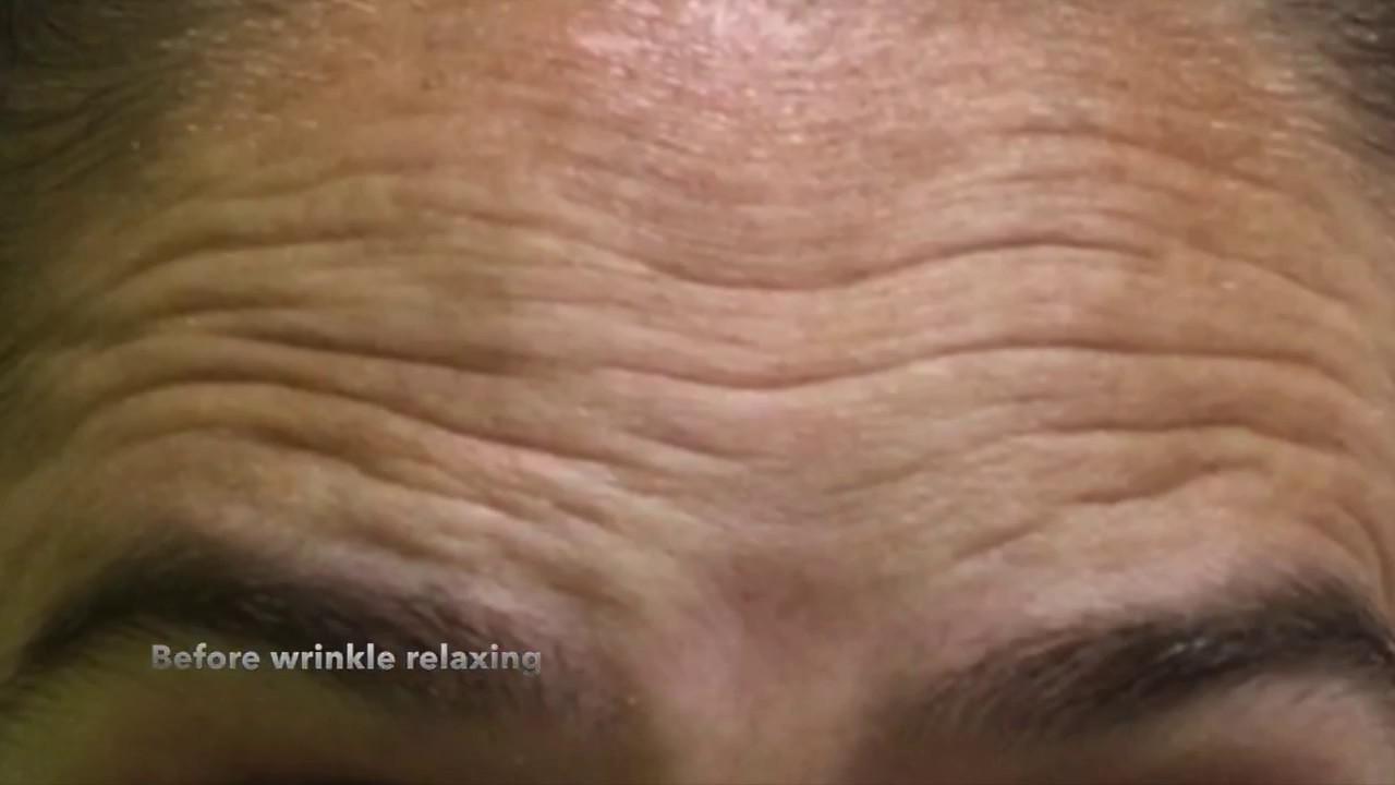 Before and After Botox Treatment Results!