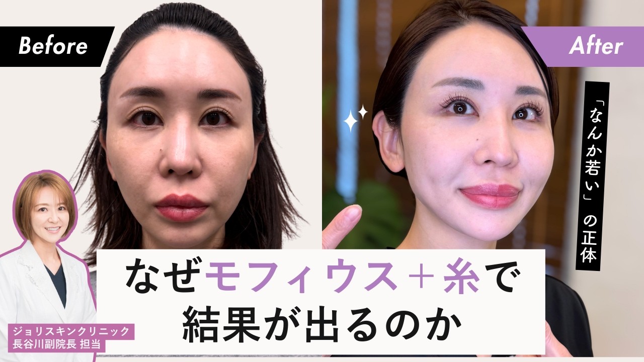 【モフィウス✖️糸リフト】機械×糸、結果が変わる設計を公開！