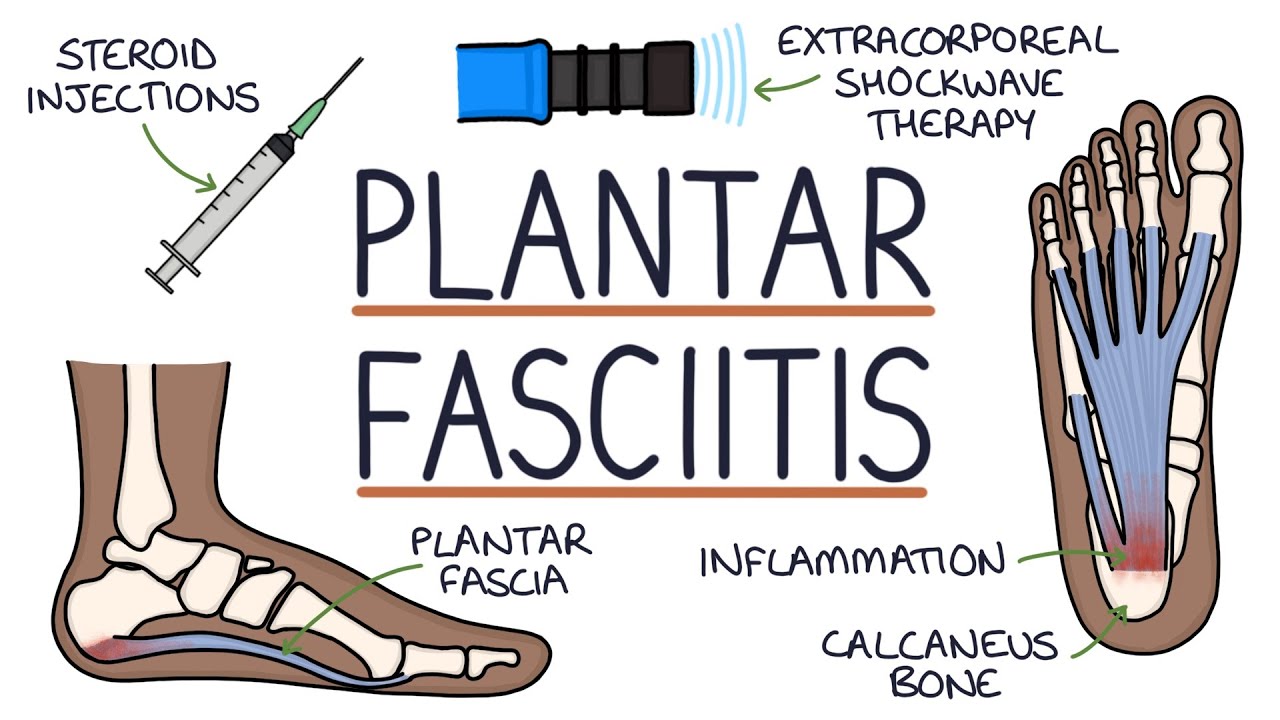 Understanding Plantar Fasciitis