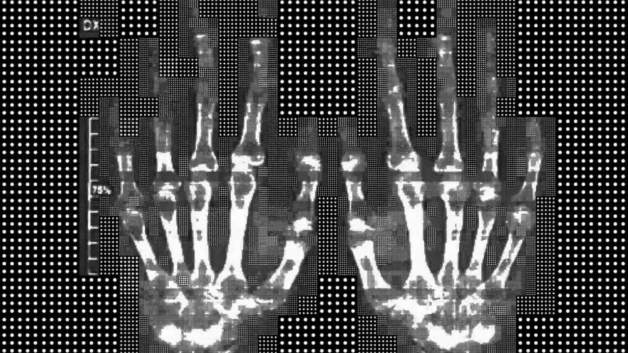 HAND AND FOREARM I CARPAL TUNNEL I RIFE Frequency No. 2008CAFL