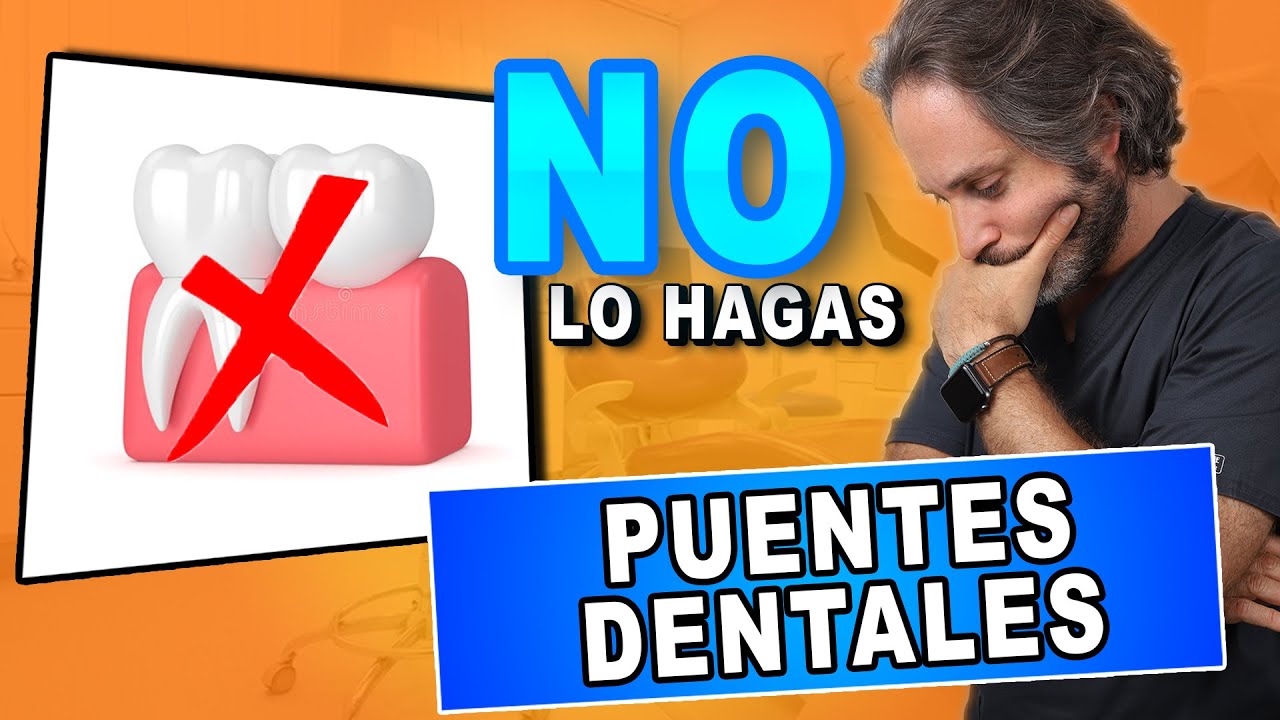 🛑𝐃𝐢𝐞𝐧𝐭𝐞𝐬 𝐅𝐢𝐣𝐨𝐬 𝐒𝐈𝐍 𝐈𝐦𝐩𝐥𝐚𝐧𝐭𝐞𝐬 dentales: El Tipo de Puente dental fijo que 𝐒𝐄𝐆𝐔𝐑𝐎 DESTRUIRÁ 💣tu BOCA