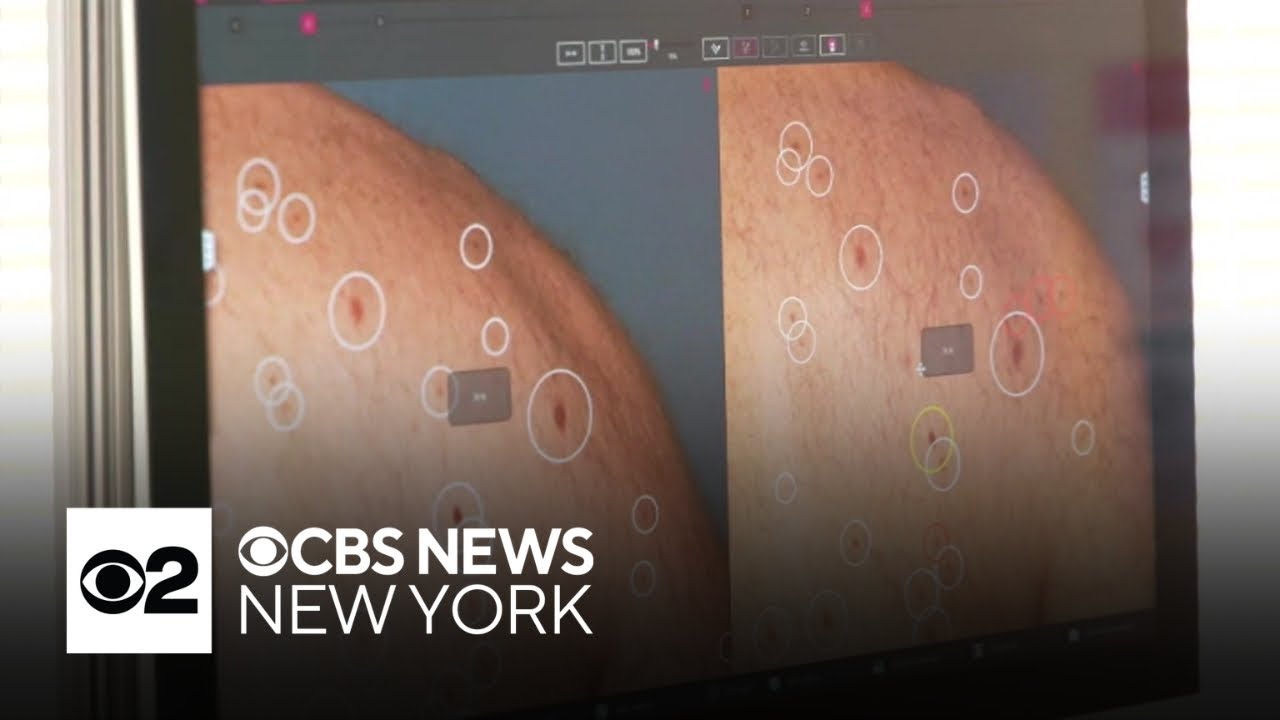Cancer vaccine trial shows promise in treating melanoma