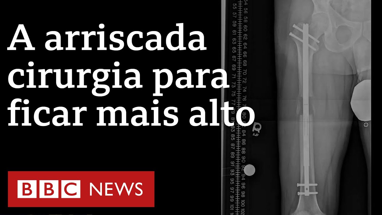 As caras, dolorosas e perigosas cirurgias que prometem aumentar altura