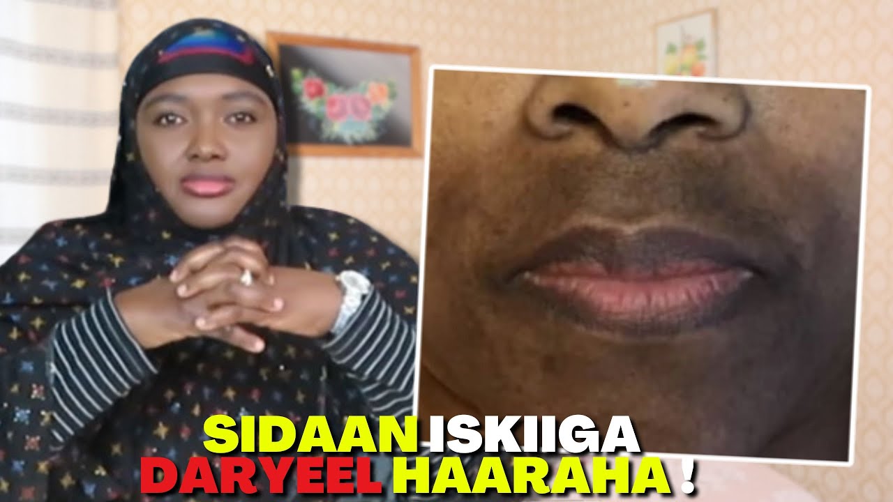 HAARAHA WAJIGA WAXA KEENO IYO SIDA LISKIIGA DARYEELO!