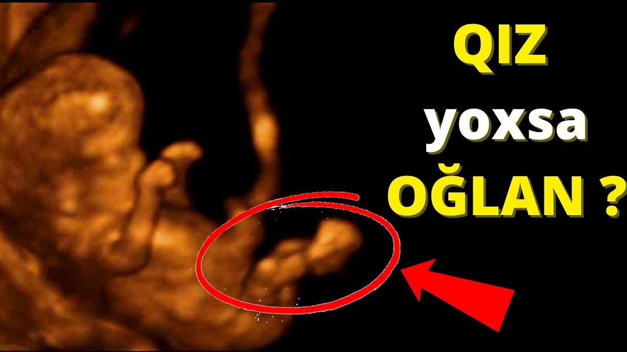 Oğlan Dedilər Qız Oldu ! - Uşağın Cinsiyyəti Səhv Yoxlana Bilərmi?