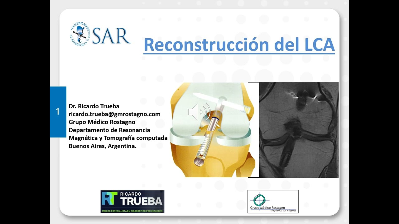 Reconstrucción del ligamento cruzado anterior