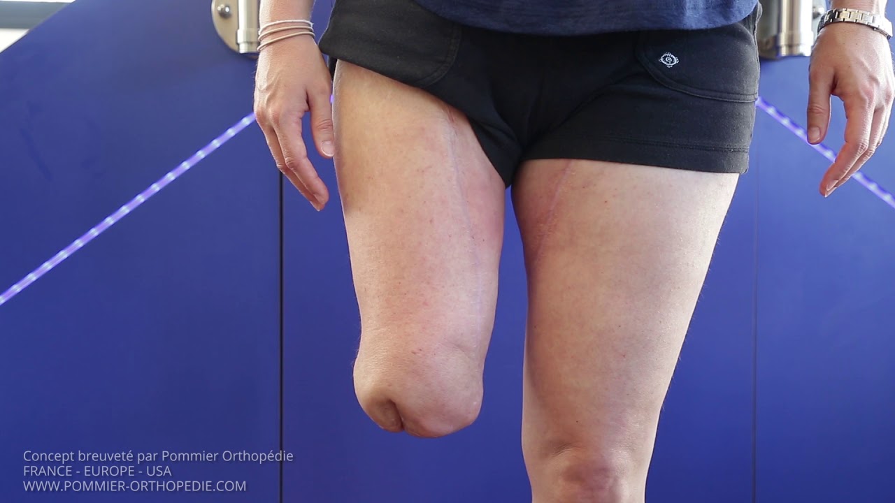 Emboiture souple I.S.S.® Breveté par Pommier Orthopédie