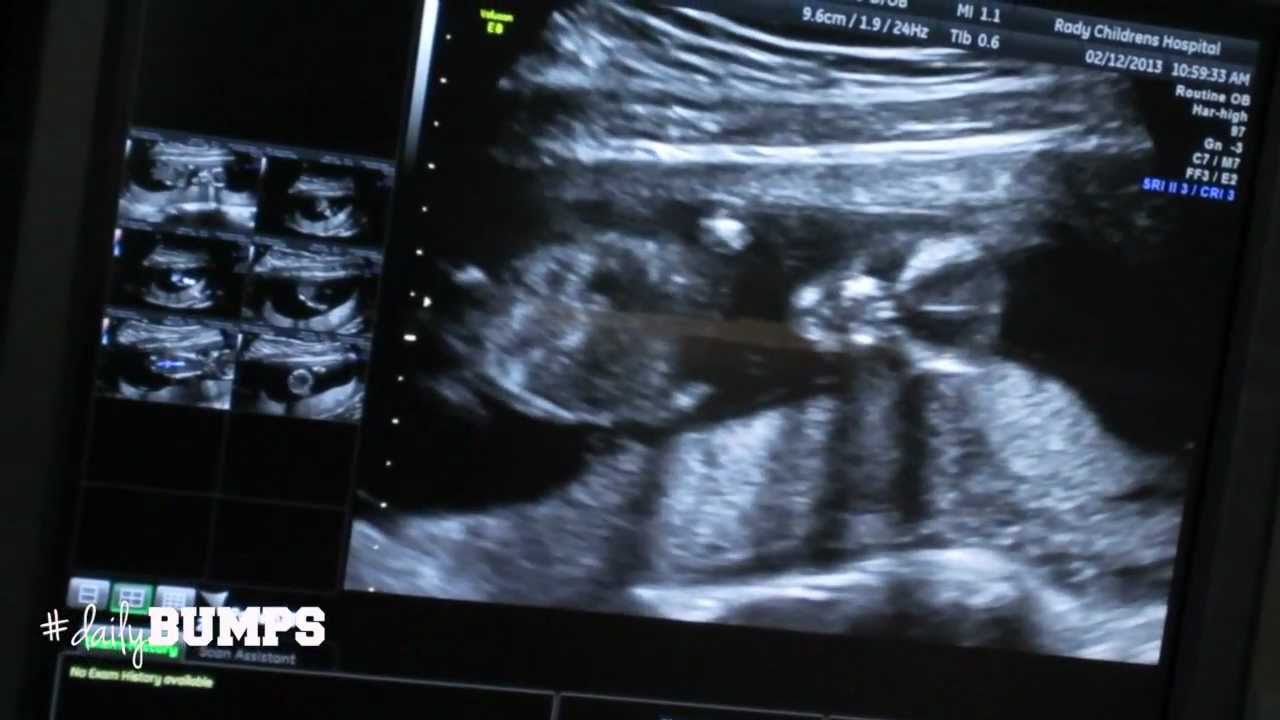 AWESOME ULTRASOUND! - Feb 12, 2013 - dailyBUMPS