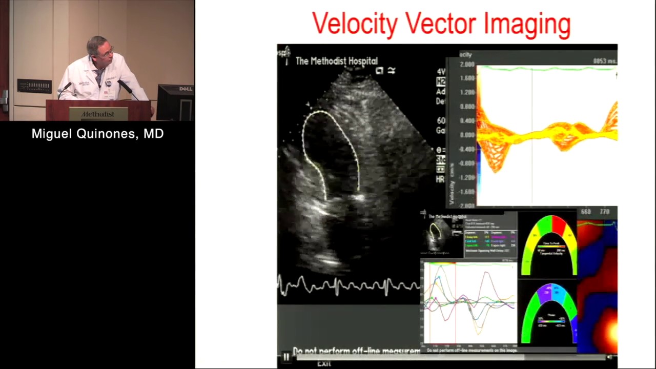 Regional Wall Motion & Stress Echo (Miguel Quinones, MD) December 6,  2016