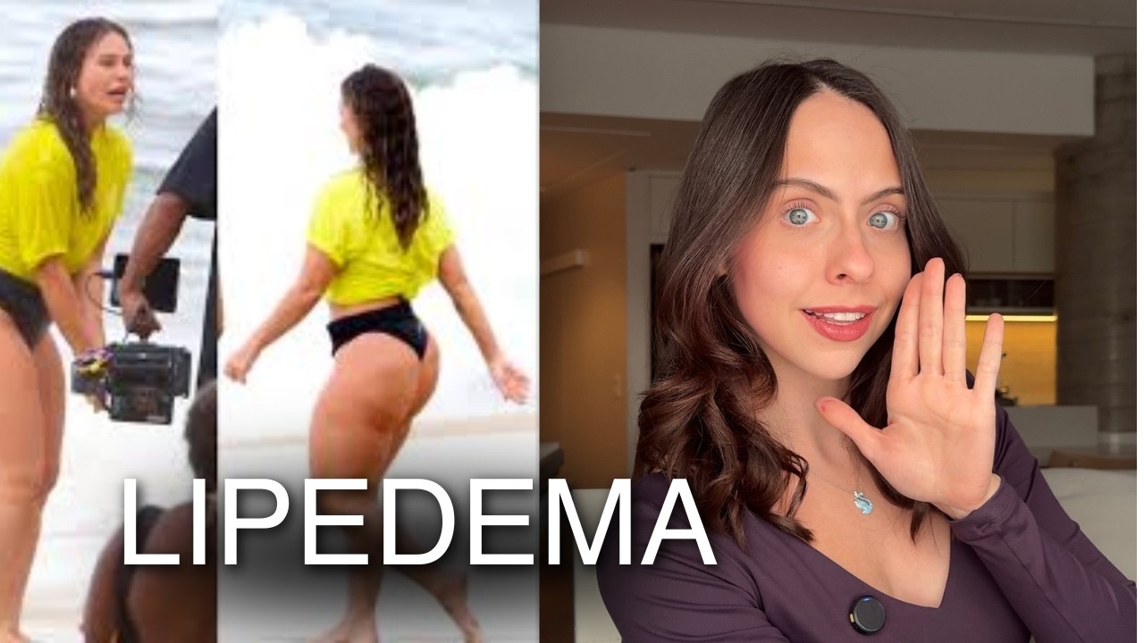 Lipedema o que é e como manejar | Lipedema tratamento natural