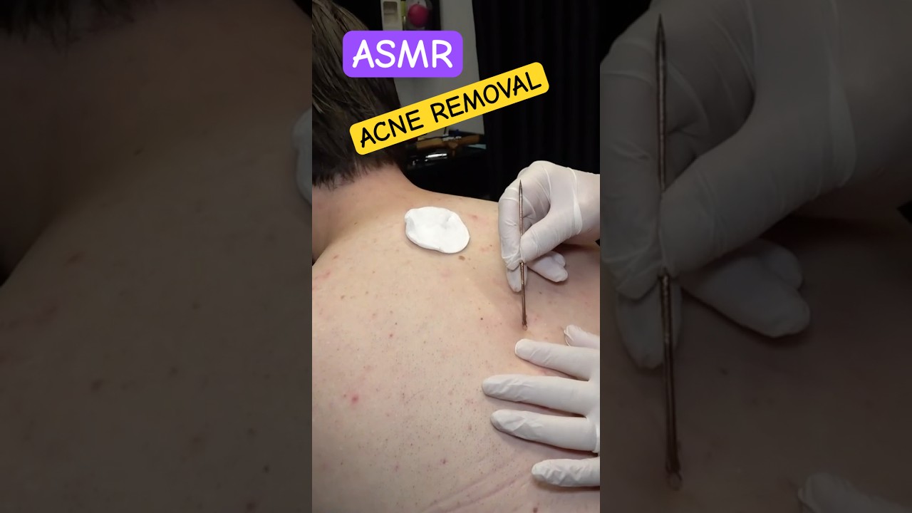 BARBER RAZOR BACK SHAVE AND ACNE REMOVAL #sleepmassage #asmr #razorshave #acneremoval #barber #relax