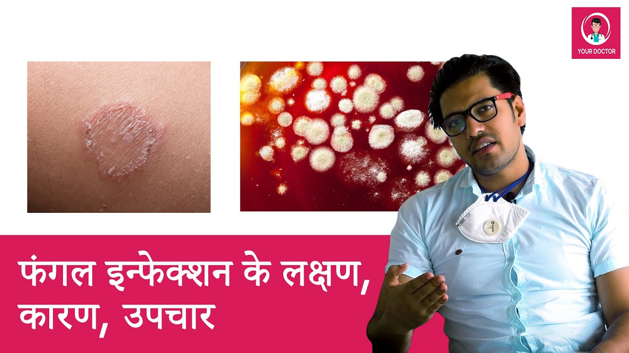 Fungal Infection Causes In Hindi | फंगल  इन्फेक्शन ( दाद ) के कारण | Your Doctor | Dr. Rajesh Narbar