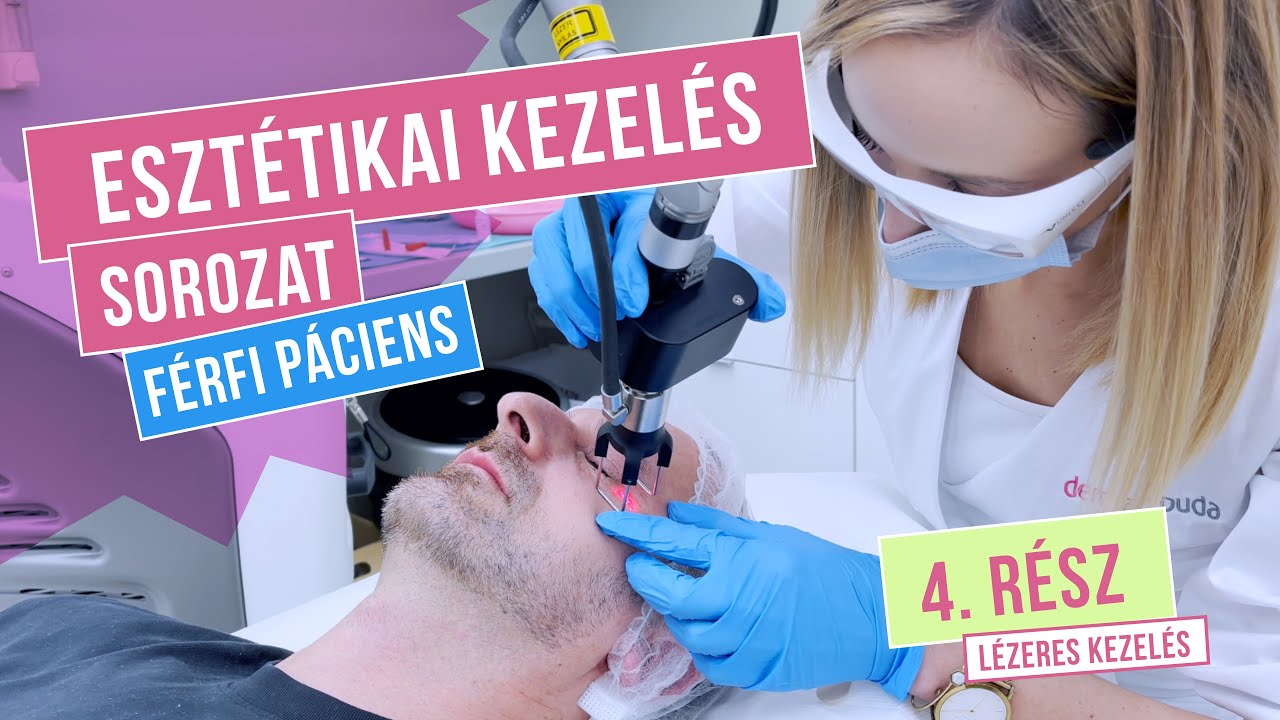 LÉZERES KEZELÉS - ESZTÉTIKAI KEZELÉS SOROZAT FÉRFI PÁCIENSEN (ZSOLT, 43) 4. RÉSZ