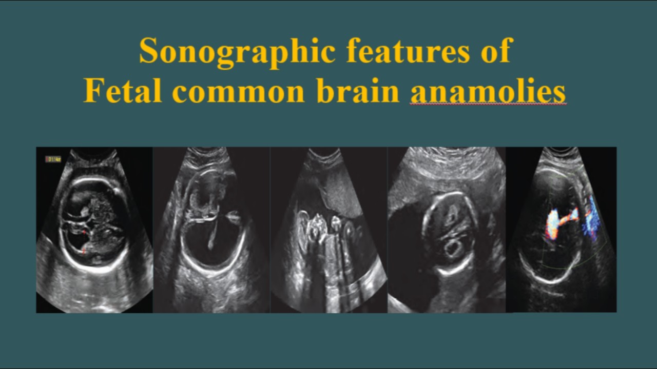 Fetal Brain Anomalies on Ultrasound | A Complete Guide to Sonographic Features