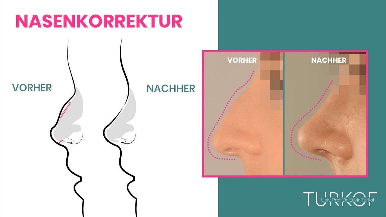 Nasenkorrektur - Nasen OP | Schönheitschirurg Univ.-Prof. Dr. Edvin Turkof