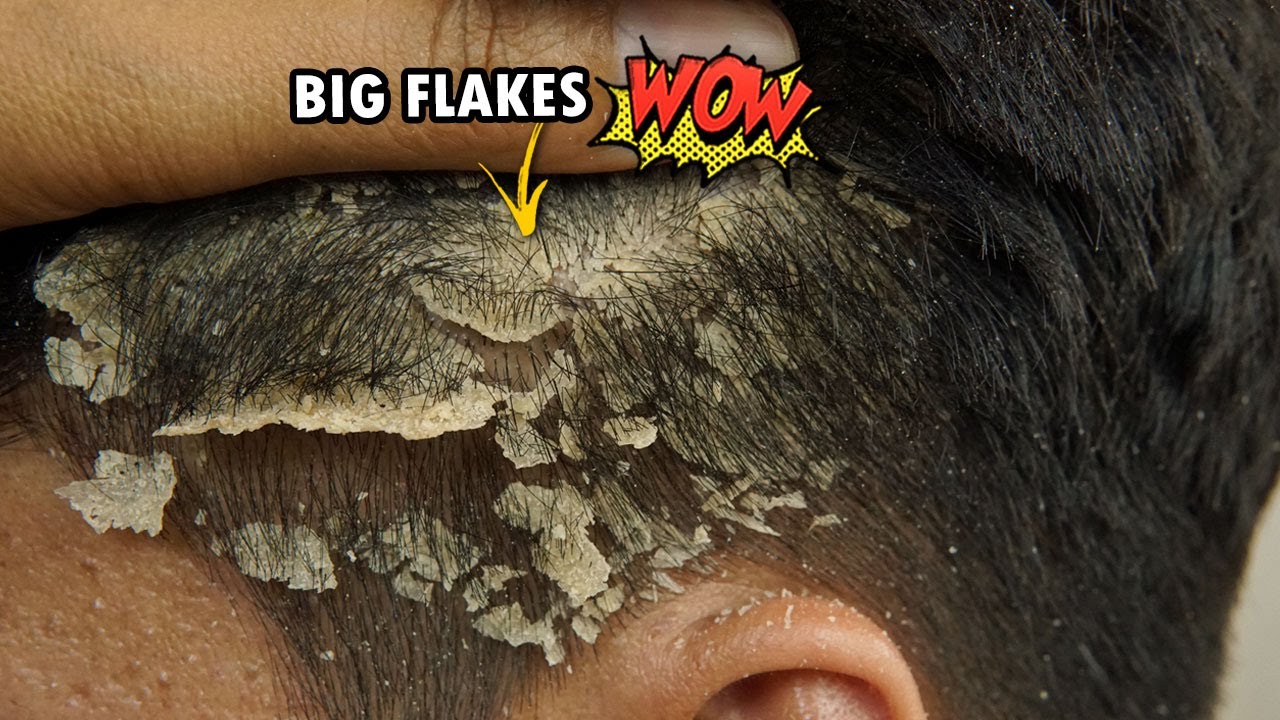 Psoriasis Scalp Scratching Flakes Satisfying #739