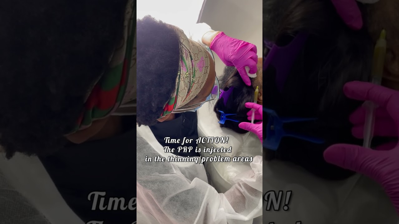 PRP Therapy At NHCG Trichology | Stimulating Natural Hair Growth @nhcgtrichology