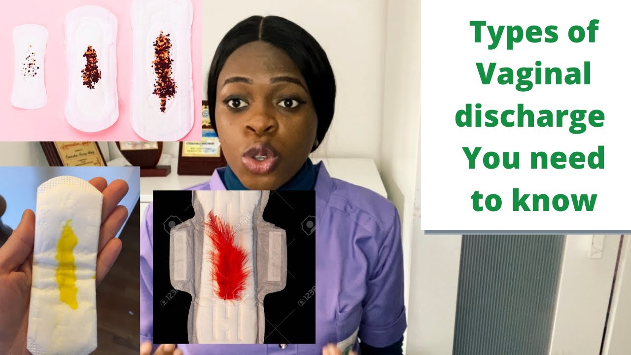 Types of vaginal discharge,causes and what to do next?