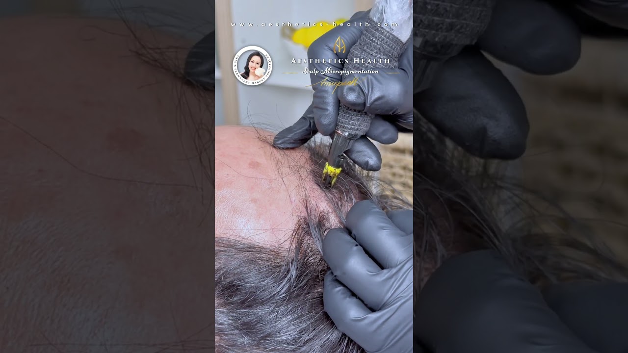 Aesthetics Health scalp micropigmentation the best solution for your hair loss 