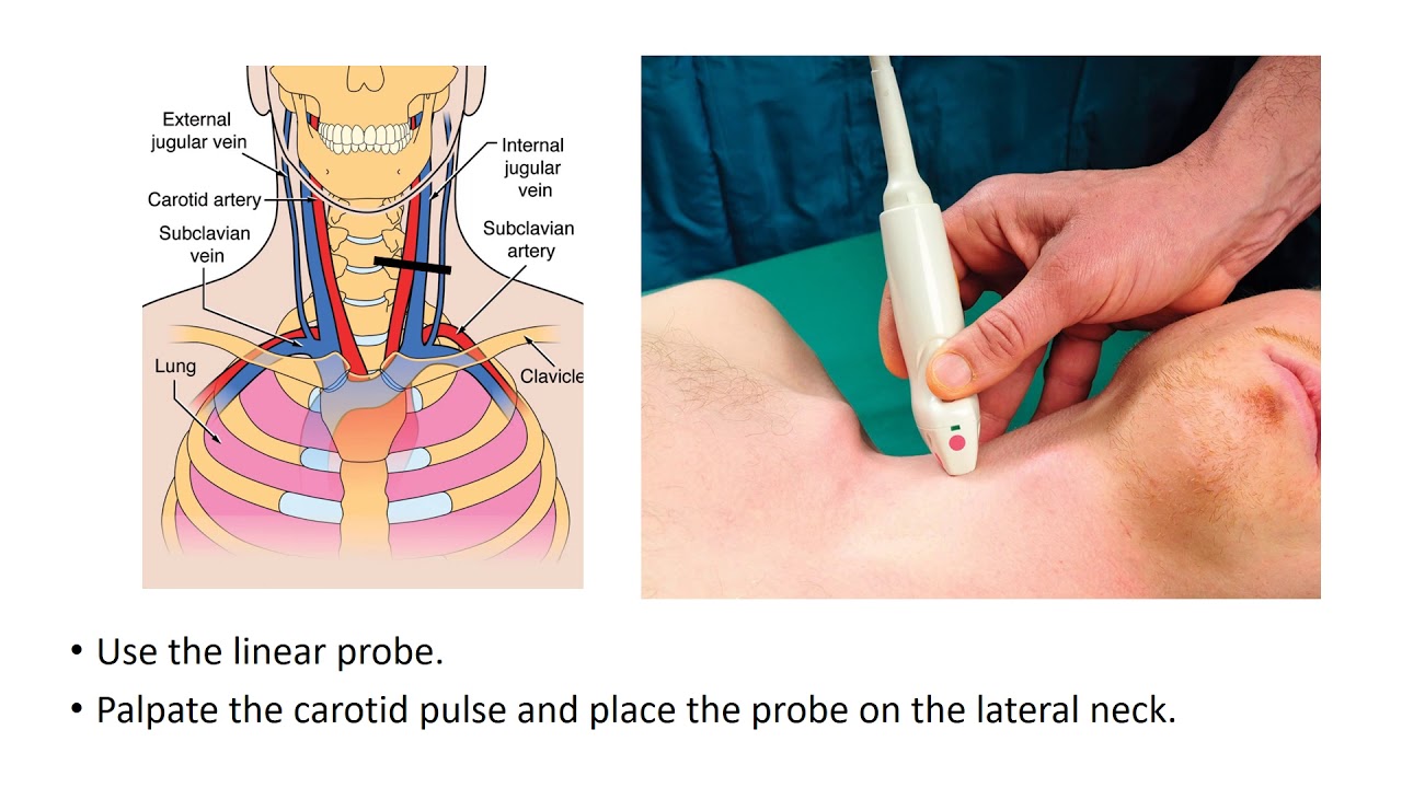 Vascular POCUS