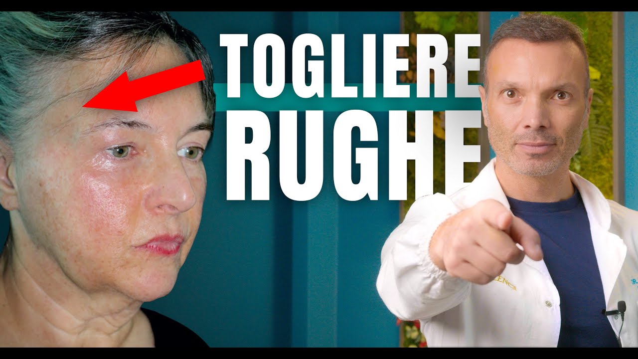 LIFTING VISO: Perché la Chirurgia è meglio delle PUNTURINE? | Dott. Dario Rochira