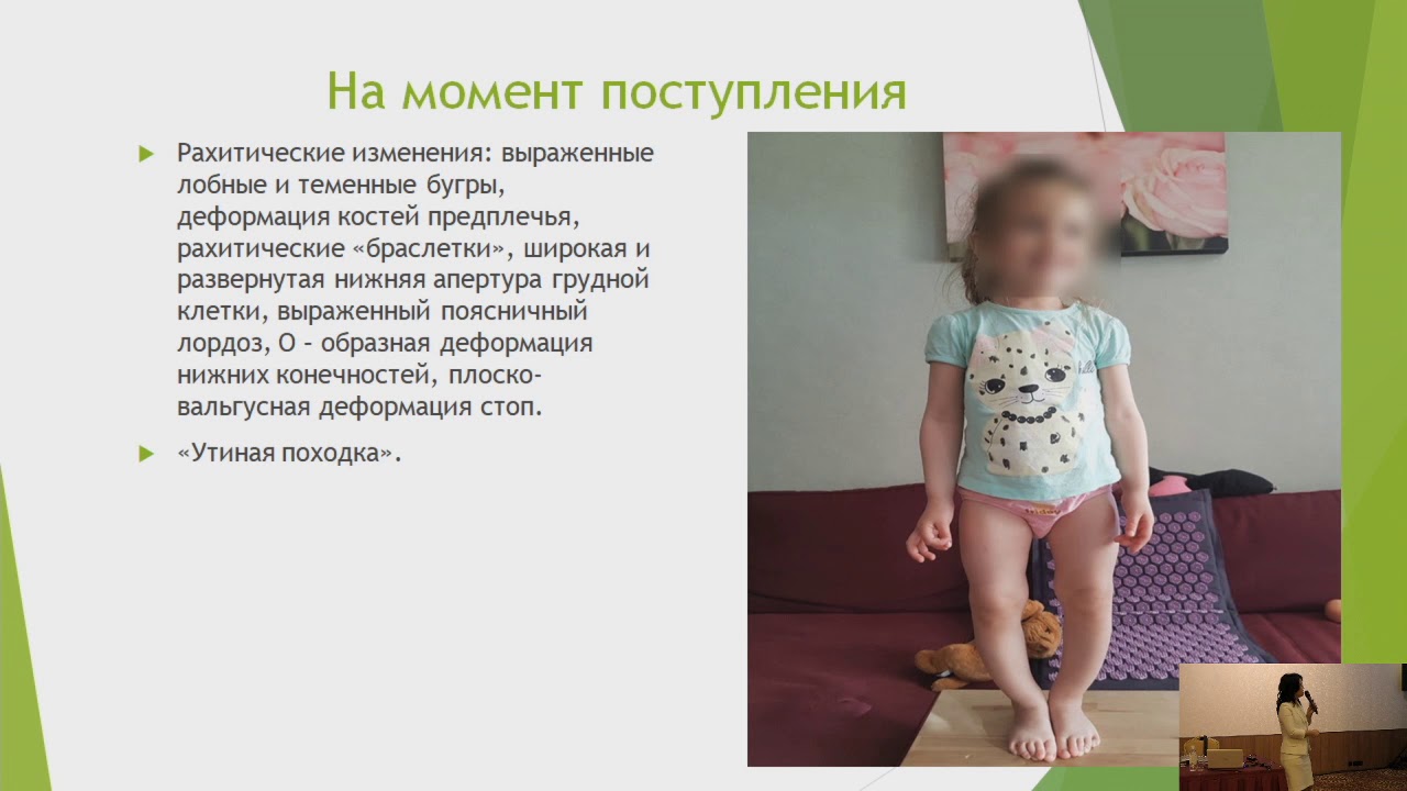 Бекмурзаева Г.Б. Гипофосфатемический рахиат.