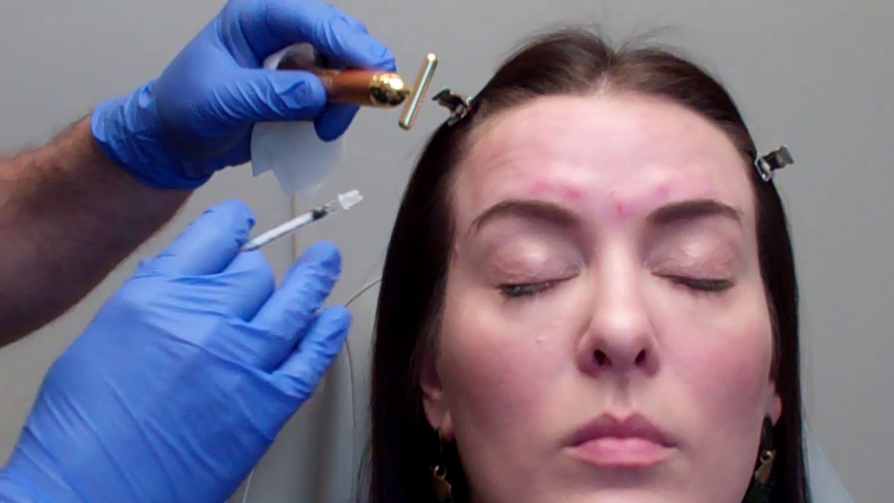 Painless Dysport Injection techniques with Dr. J