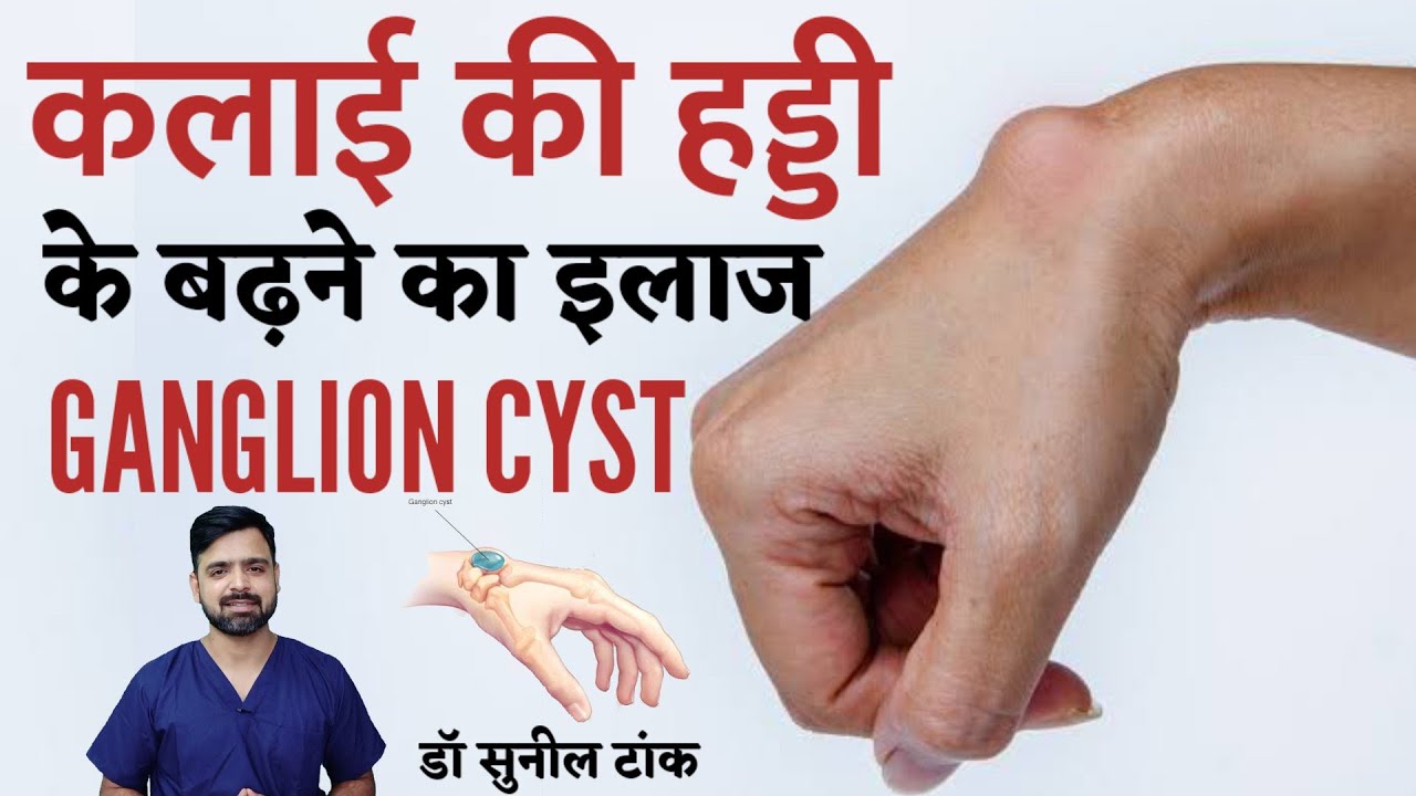 कलाई की हड्डी का बढ़ना | Effective physiotherapy exercises for wrist ganglion cysts | Dr Sunil Tank