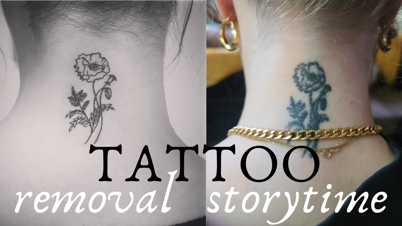 getting my tattoo removed || STORY TIME