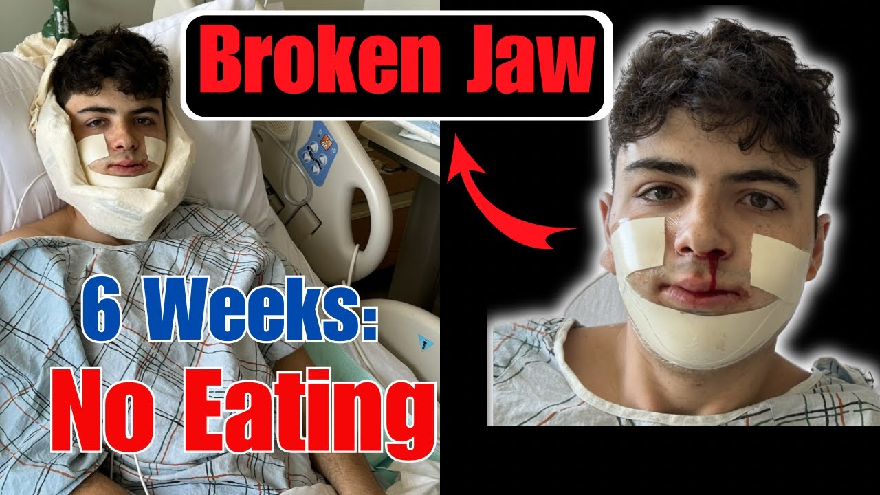 I Broke My Jaw | No Food + Surgery